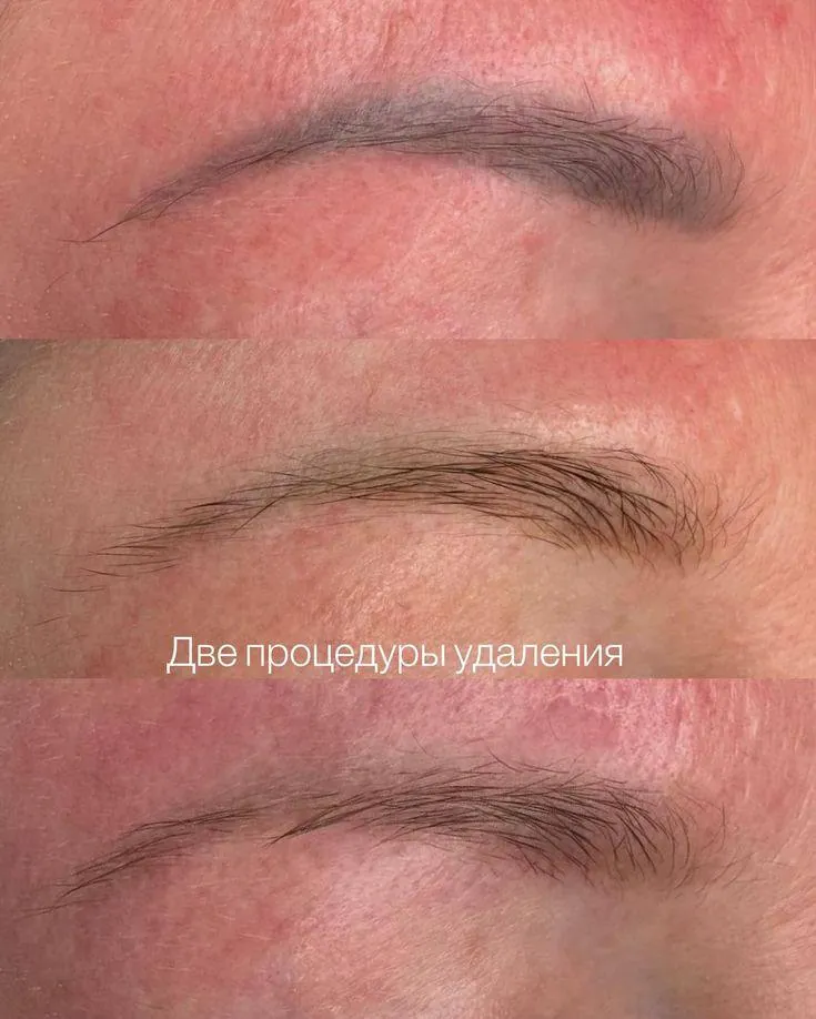 Удаление перманента бровей лазером: результат после двух процедур